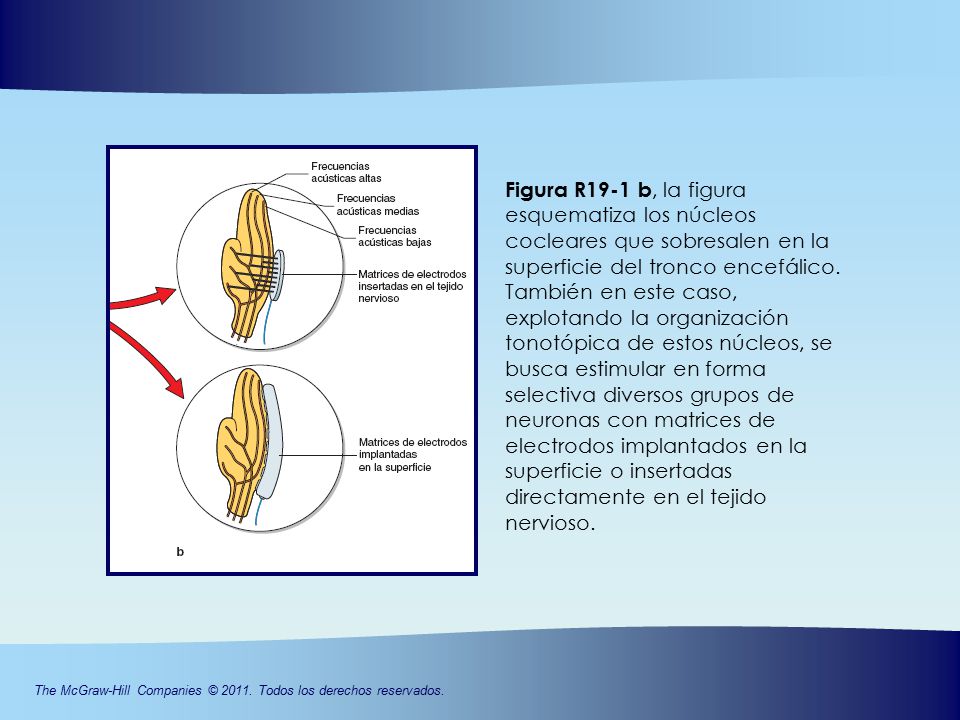 Figura R19-1 b, la figura esquematiza los núcleos cocleares que sobresalen en la superficie del tronco encefálico.