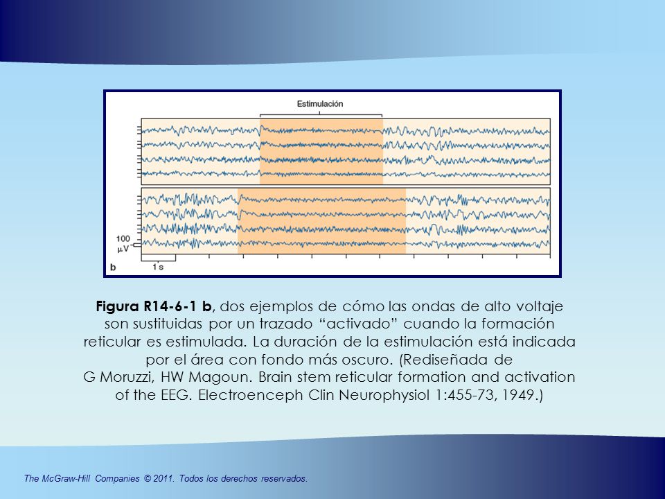 Figura R b, dos ejemplos de cómo las ondas de alto voltaje son sustituidas por un trazado activado cuando la formación reticular es estimulada.