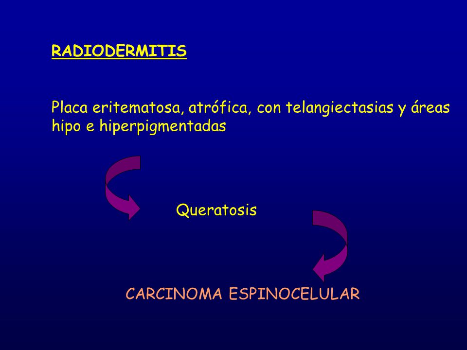 RADIODERMITIS Placa eritematosa, atrófica, con telangiectasias y áreas hipo e hiperpigmentadas. Queratosis.