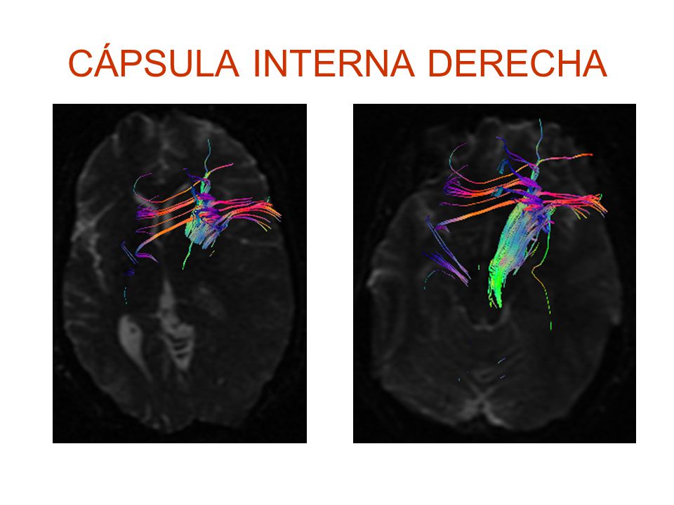 CÁPSULA INTERNA DERECHA