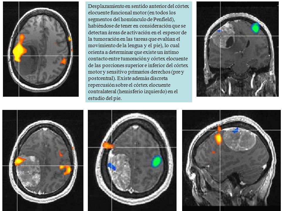 Desplazamiento en sentido anterior del córtex elocuente funcional motor (en todos los segmentos del homúnculo de Penfield),