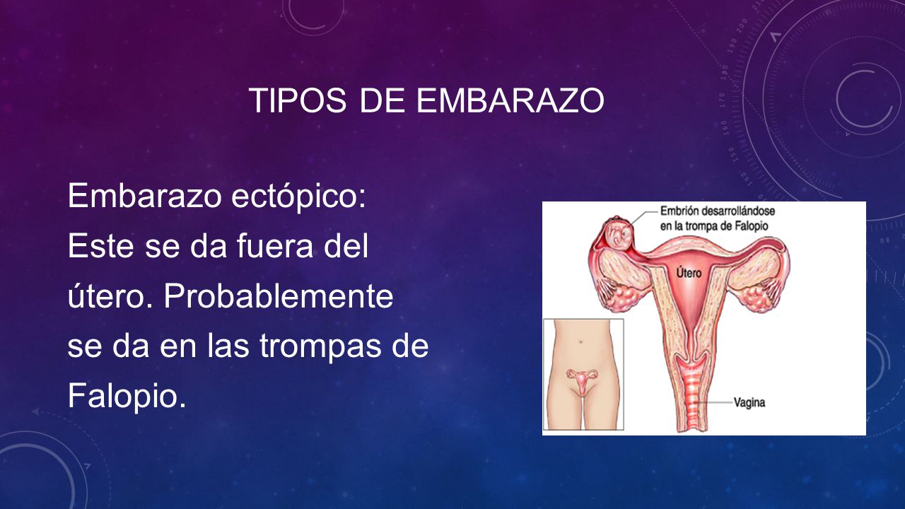 Tipos de embarazo Embarazo ectópico: Este se da fuera del útero.