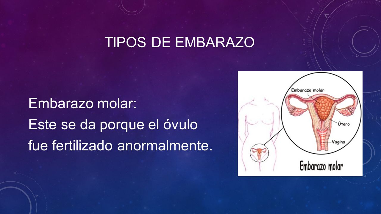 tipos de embarazo Embarazo molar: Este se da porque el óvulo fue fertilizado anormalmente.