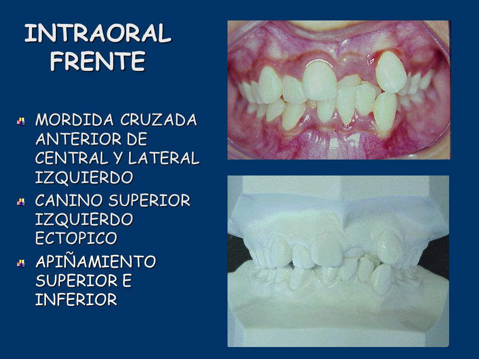 INTRAORAL FRENTE MORDIDA CRUZADA ANTERIOR DE CENTRAL Y LATERAL IZQUIERDO. CANINO SUPERIOR IZQUIERDO ECTOPICO.