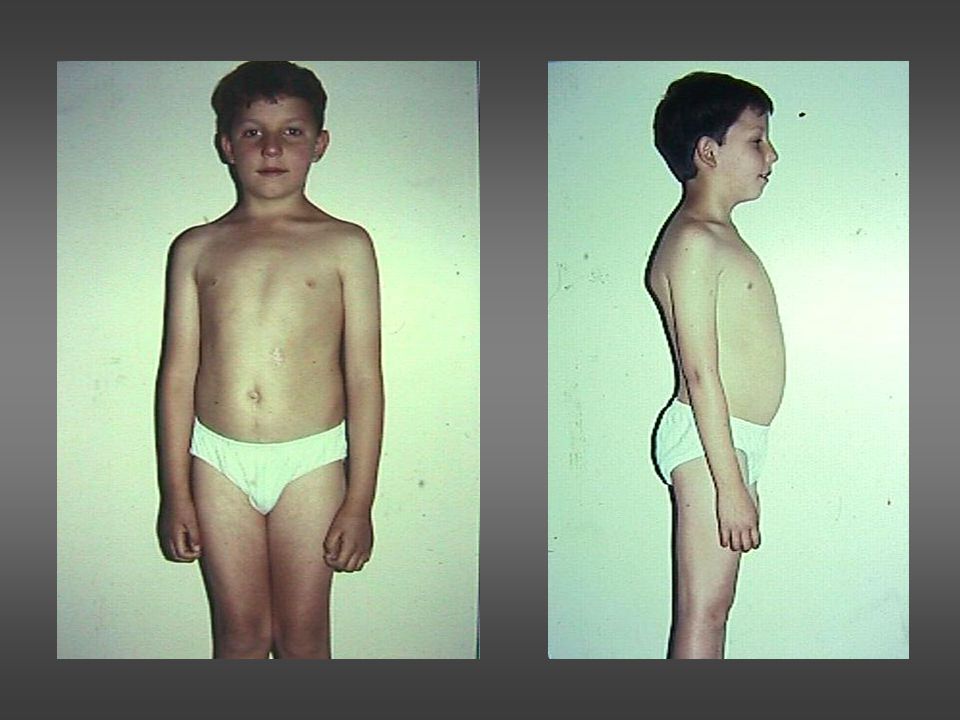 El mismo niño luego de 8 meses de su operación.