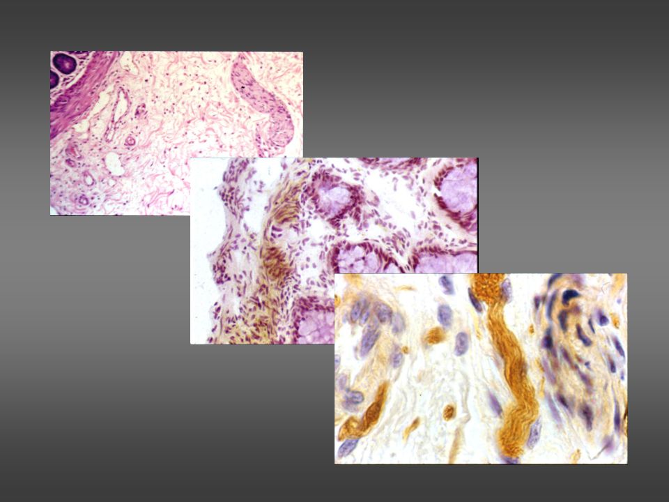 Estudios Microscópicos para determinar la ausencia de células ganglionares en el colon y otras características de la E.