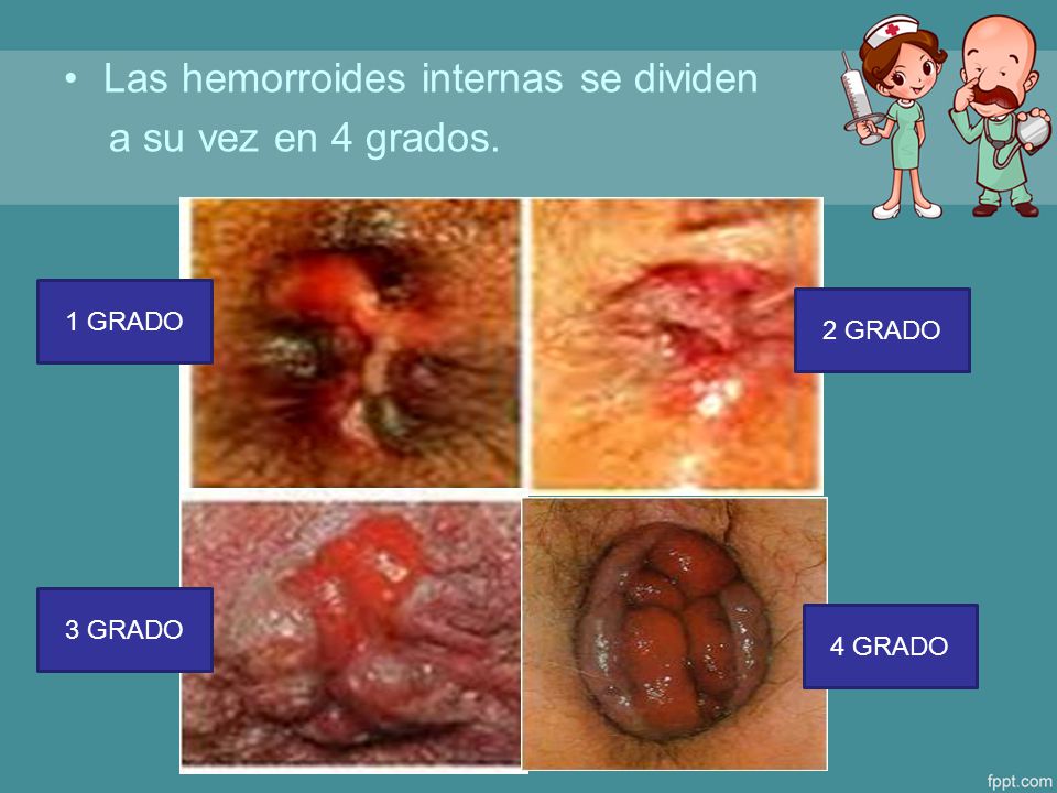 Las hemorroides internas se dividen a su vez en 4 grados.