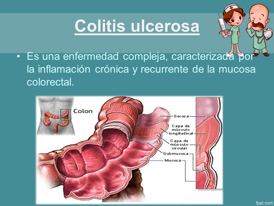 Colitis ulcerosa Es una enfermedad compleja, caracterizada por la inflamación crónica y recurrente de la mucosa colorectal.