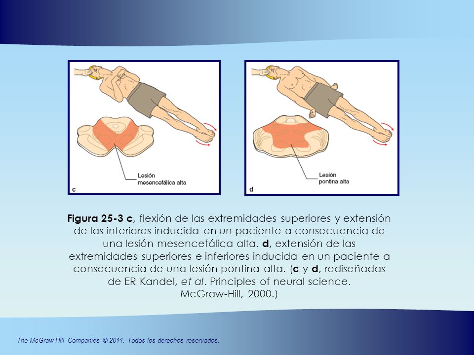 Figura 25-3 c, flexión de las extremidades superiores y extensión de las inferiores inducida en un paciente a consecuencia de una lesión mesencefálica alta.