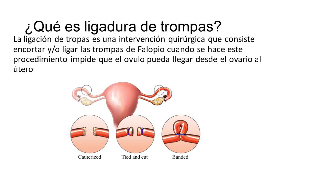 ¿Qué es ligadura de trompas