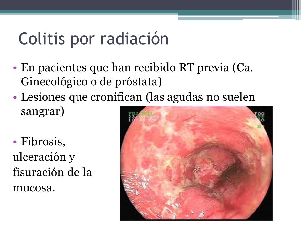 Colitis por radiación En pacientes que han recibido RT previa (Ca. Ginecológico o de próstata)