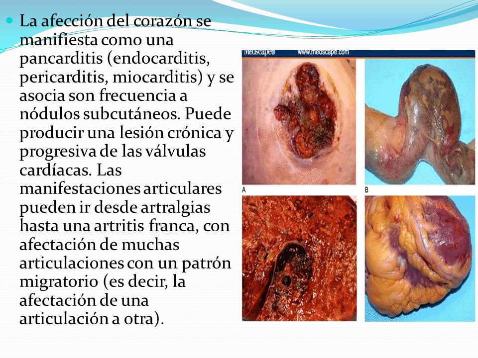 La afección del corazón se manifiesta como una pancarditis (endocarditis, pericarditis, miocarditis) y se asocia son frecuencia a nódulos subcutáneos.