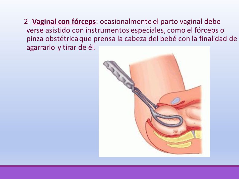 2- Vaginal con fórceps: ocasionalmente el parto vaginal debe verse asistido con instrumentos especiales, como el fórceps o pinza obstétrica que prensa la cabeza del bebé con la finalidad de agarrarlo y tirar de él.