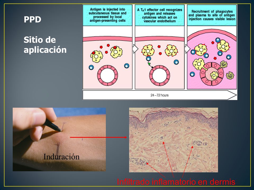 PPD Sitio de aplicación Infiltrado inflamatorio en dermis Induración