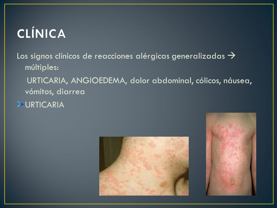 CLÍNICA Los signos clínicos de reacciones alérgicas generalizadas  múltiples: