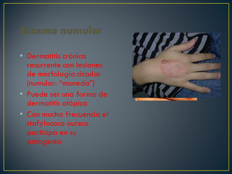 Eccema numular Dermatitis crónica recurrente con lesiones de morfología circular (numular: moneda )