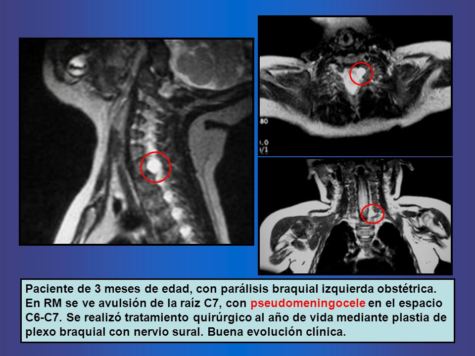 Paciente de 3 meses de edad, con parálisis braquial izquierda obstétrica.