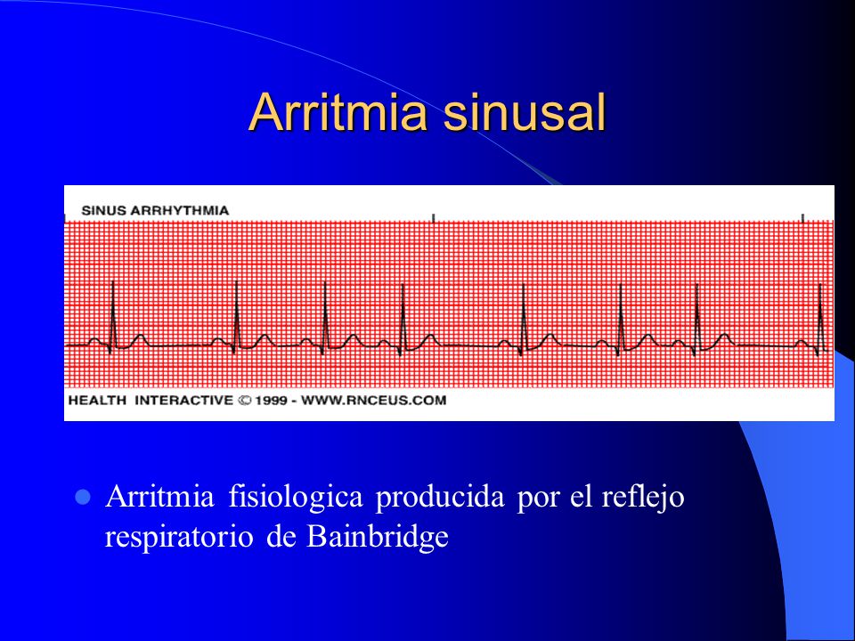 Arritmia sinusal Arritmia fisiologica producida por el reflejo respiratorio de Bainbridge