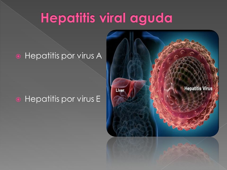 Hepatitis viral aguda Hepatitis por virus A Hepatitis por virus E