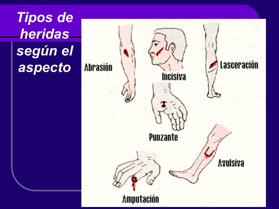 Tipos de heridas según el aspecto