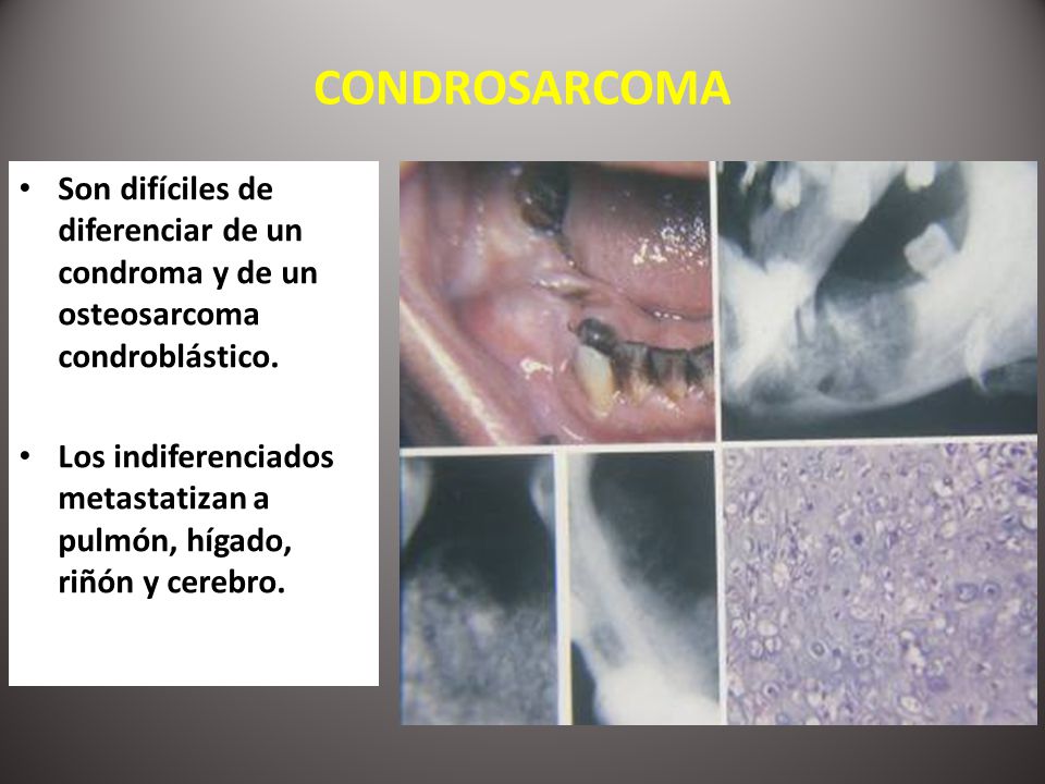 CONDROSARCOMA Son difíciles de diferenciar de un condroma y de un osteosarcoma condroblástico.