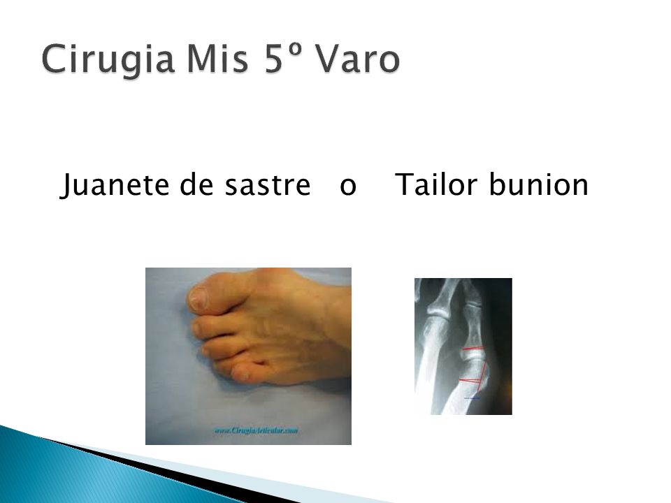 Cirugia Mis 5º Varo Juanete de sastre o Tailor bunion