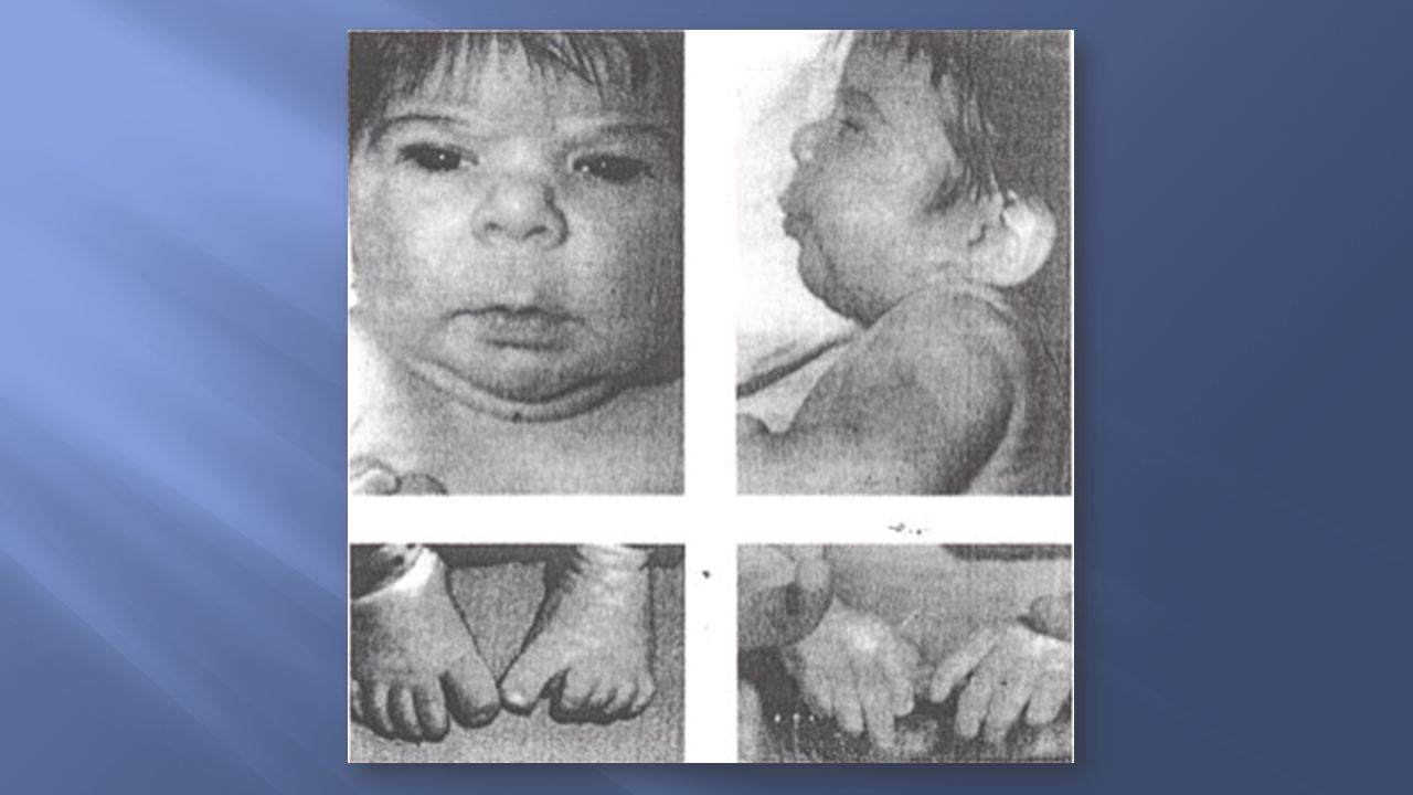 Hidantoína síndrome fetal: rasgos faciales - repunte nariz, hipoplasia mediofacial suave, largo con labio superior delgado y bermellón frontera inferior distal hipoplasia digital.