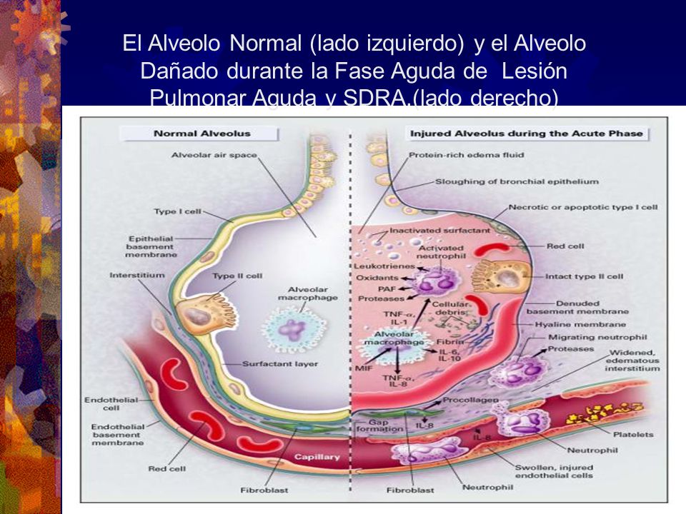 El Alveolo Normal (lado izquierdo) y el Alveolo Dañado durante la Fase Aguda de Lesión Pulmonar Aguda y SDRA.(lado derecho)