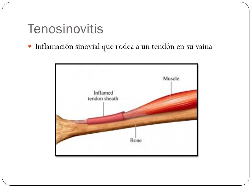 Tenosinovitis Inflamación sinovial que rodea a un tendón en su vaina