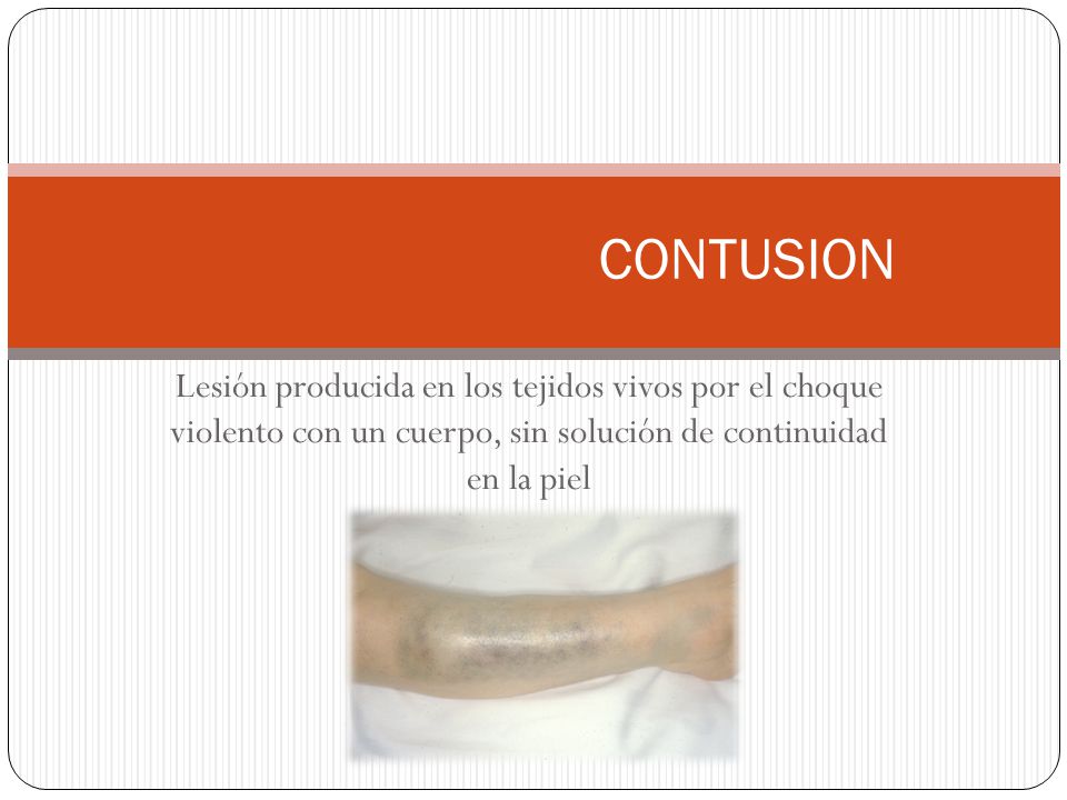 CONTUSION Lesión producida en los tejidos vivos por el choque violento con un cuerpo, sin solución de continuidad en la piel.