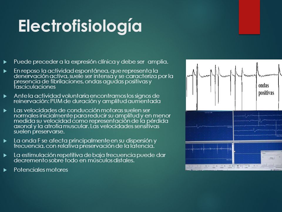 Electrofisiología Puede preceder a la expresión clínica y debe ser amplia.