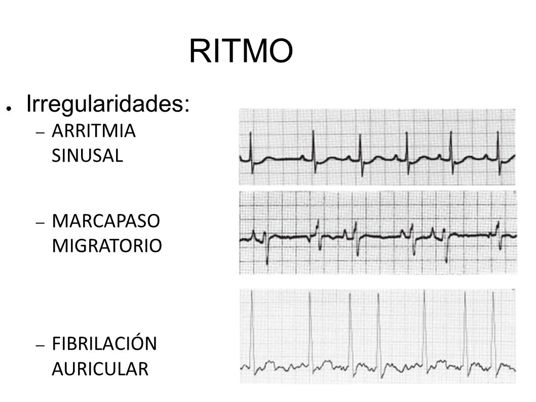 RITMO Irregularidades: ARRITMIA SINUSAL MARCAPASO MIGRATORIO
