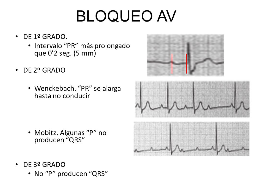 BLOQUEO AV DE 1º GRADO. Intervalo PR más prolongado que 0’2 seg. (5 mm) DE 2º GRADO. Wenckebach. PR se alarga hasta no conducir.