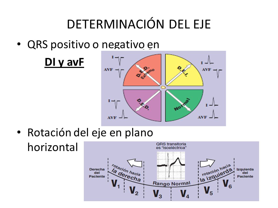 DETERMINACIÓN DEL EJE QRS positivo o negativo en DI y avF