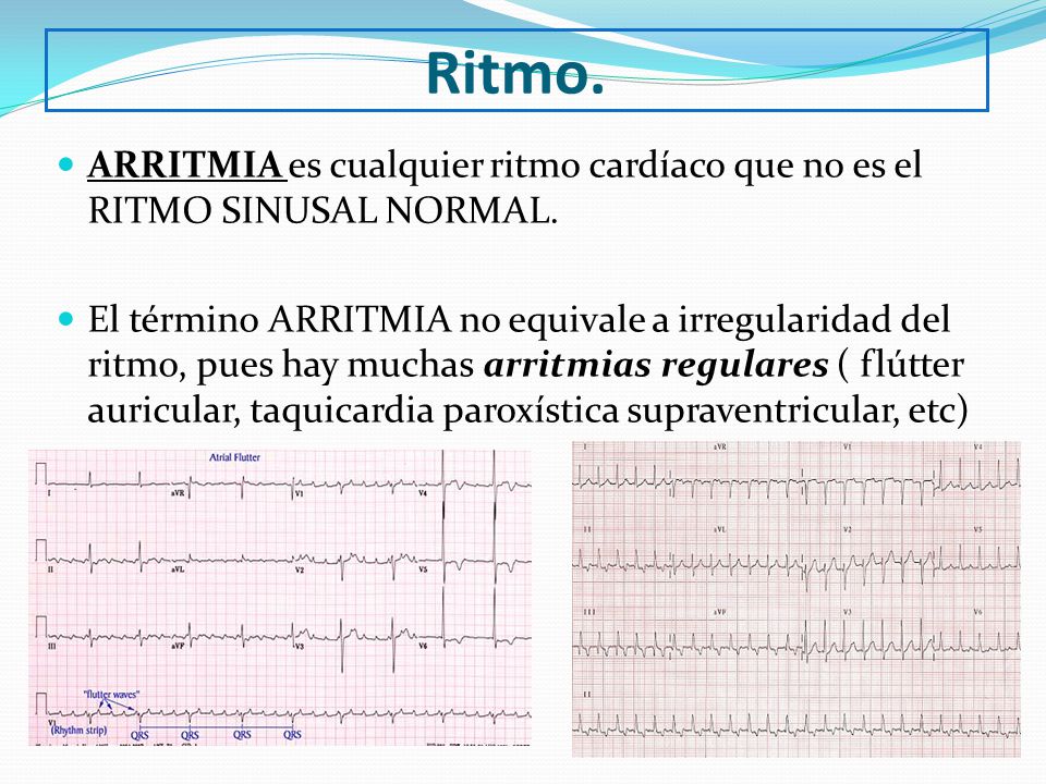 Ritmo. ARRITMIA es cualquier ritmo cardíaco que no es el RITMO SINUSAL NORMAL.