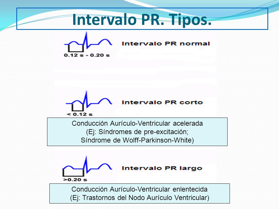 Intervalo PR. Tipos. Conducción Aurículo-Ventricular acelerada