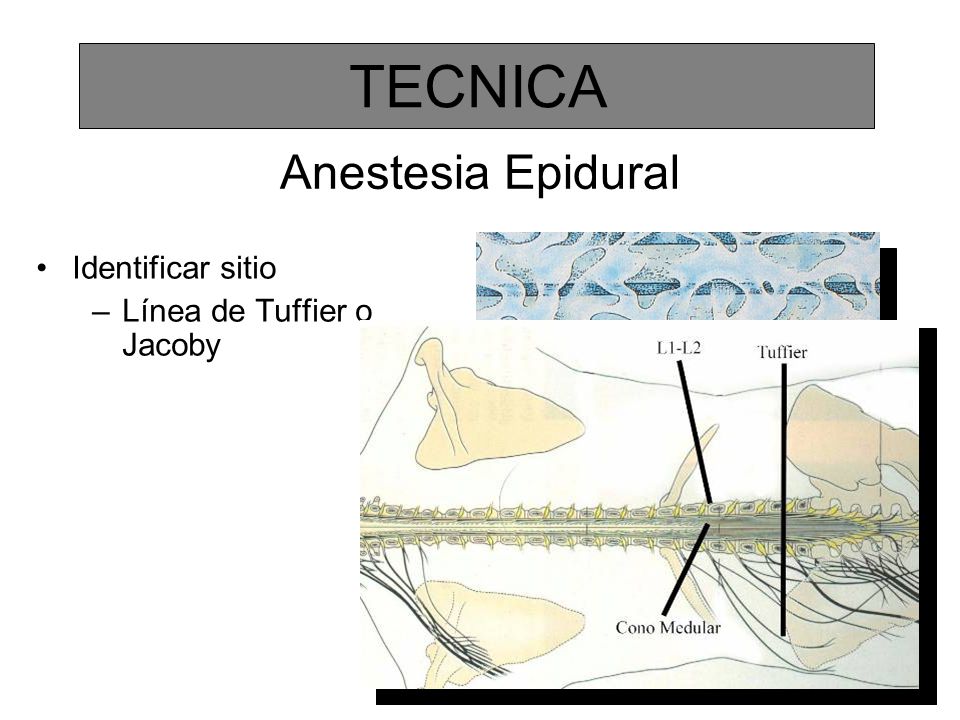 TECNICA Anestesia Epidural Identificar sitio Línea de Tuffier o Jacoby