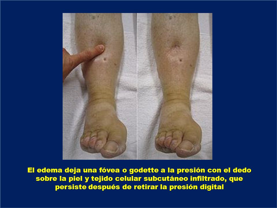 El edema deja una fóvea o godette a la presión con el dedo sobre la piel y tejido celular subcutáneo infiltrado, que persiste después de retirar la presión digital