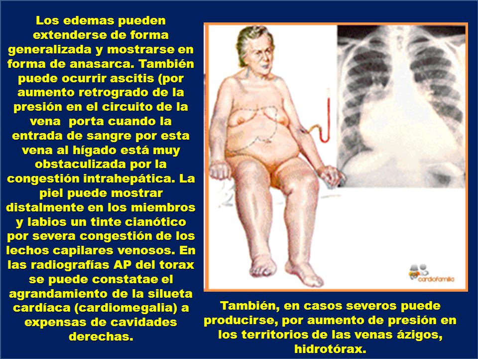 Los edemas pueden extenderse de forma generalizada y mostrarse en forma de anasarca. También puede ocurrir ascitis (por aumento retrogrado de la presión en el circuito de la vena porta cuando la entrada de sangre por esta vena al hígado está muy obstaculizada por la congestión intrahepática. La piel puede mostrar distalmente en los miembros y labios un tinte cianótico por severa congestión de los lechos capilares venosos. En las radiografías AP del torax se puede constatae el agrandamiento de la silueta cardíaca (cardiomegalia) a expensas de cavidades derechas.