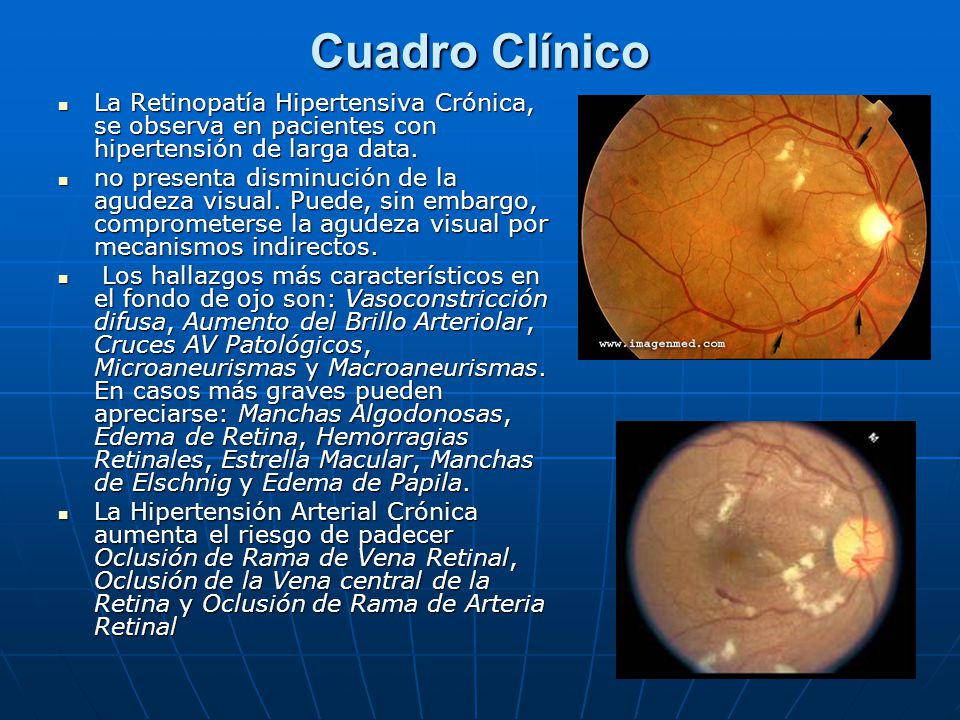 retinopatia diabetica clinica)