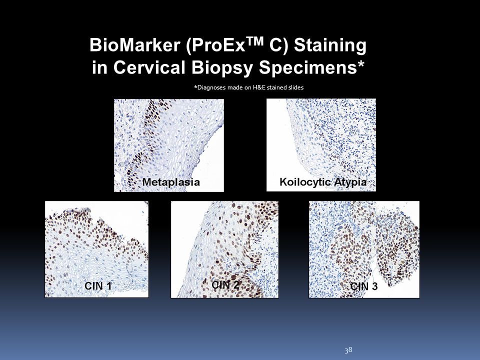 BioMarker (ProExTM C) Staining in Cervical Biopsy Specimens*