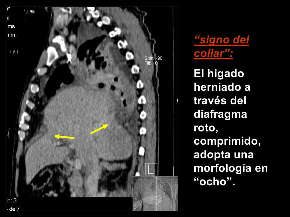 signo del collar : El higado herniado a través del diafragma roto, comprimido, adopta una morfología en ocho .