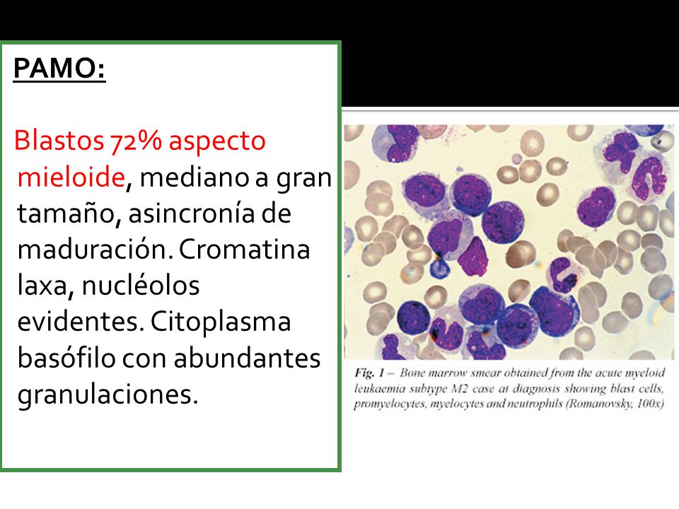 PAMO: Blastos 72% aspecto mieloide, mediano a gran tamaño, asincronía de maduración.