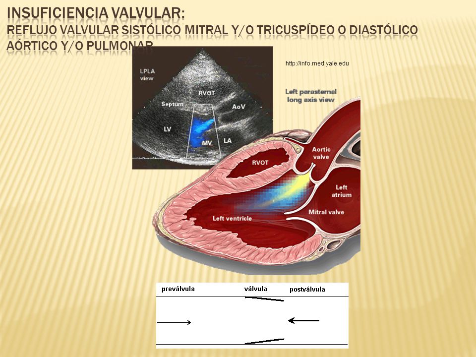 Insuficiencia valvular: Reflujo valvular sistólico mitral y/o tricuspídeo o diastólico aórtico y/o pulmonar