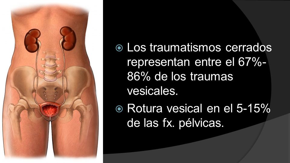 Los traumatismos cerrados representan entre el 67%-86% de los traumas vesicales.