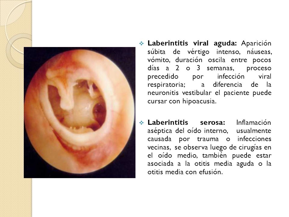 Laberintitis viral aguda: Aparición súbita de vértigo intenso, náuseas, vómito, duración oscila entre pocos días a 2 o 3 semanas, proceso precedido por infección viral respiratoria; a diferencia de la neuronitis vestibular el paciente puede cursar con hipoacusia.