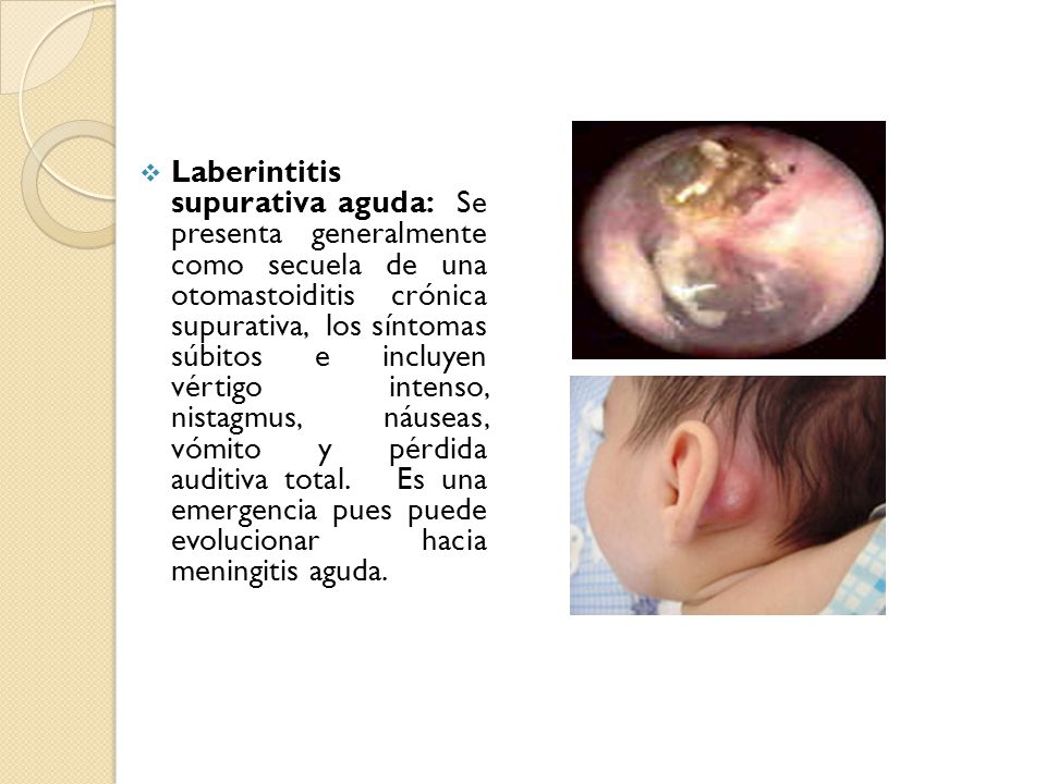Laberintitis supurativa aguda: Se presenta generalmente como secuela de una otomastoiditis crónica supurativa, los síntomas súbitos e incluyen vértigo intenso, nistagmus, náuseas, vómito y pérdida auditiva total.