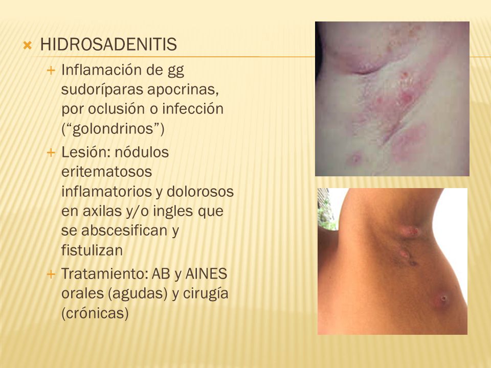 HIDROSADENITIS Inflamación de gg sudoríparas apocrinas, por oclusión o infección ( golondrinos )