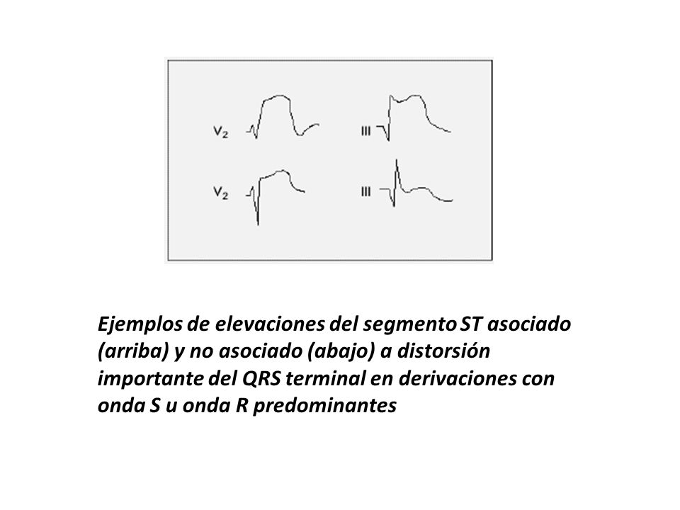 Ejemplos de elevaciones del segmento ST asociado (arriba) y no asociado (abajo) a distorsión importante del QRS terminal en derivaciones con onda S u onda R predominantes