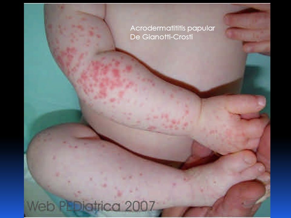 Acrodermatititis papular